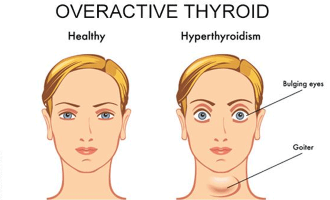 Diet For Hyperactive Thyroid And Pregnancy