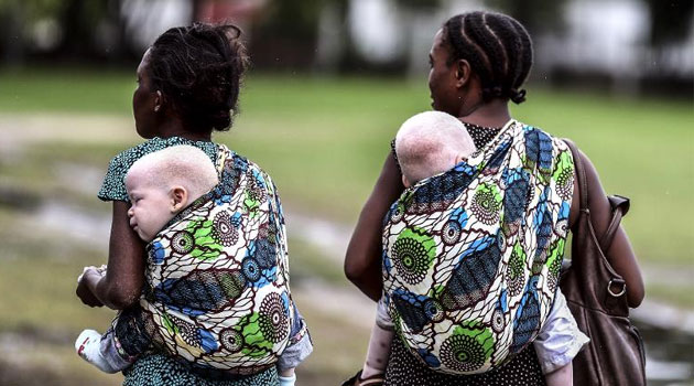 Albino children carried on the back/FILE