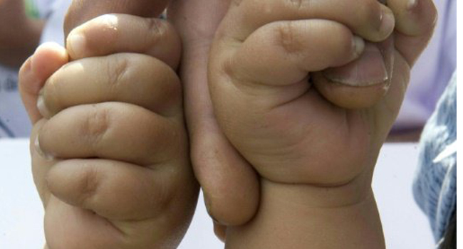 Hands of identical twins/AFP 