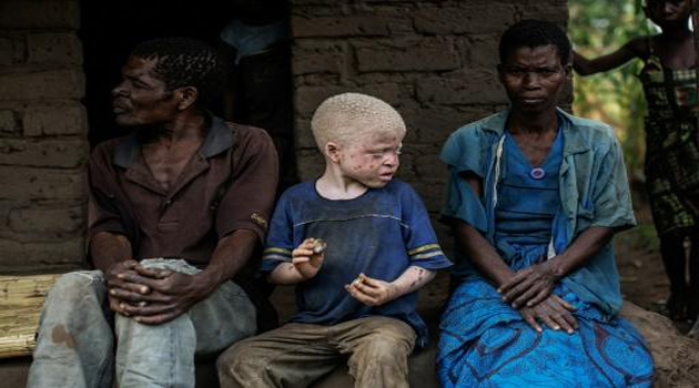  The slaughter of albinos is also prevalent in Tanzania and Mozambique/AFP